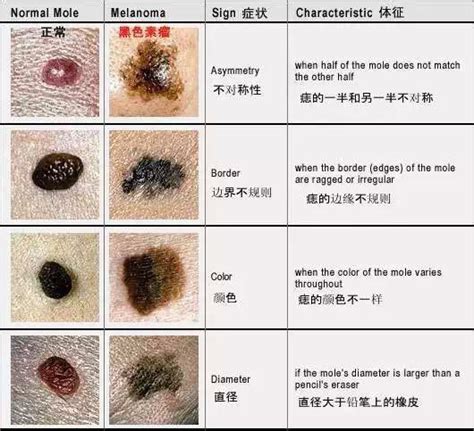 為什麼會長黑痣|痣是什麼？一次了解痣原因、就醫時機以及如何改善